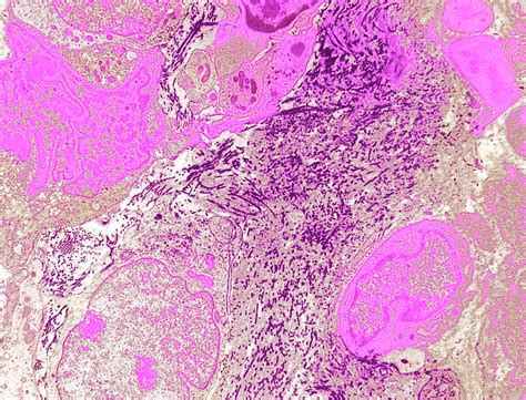 imaging tests for adult soft tissue sarcoma|is soft tissue sarcoma deadly.